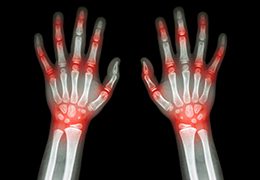 Arthritis Pain Relief and Treatment with QC Kinetix