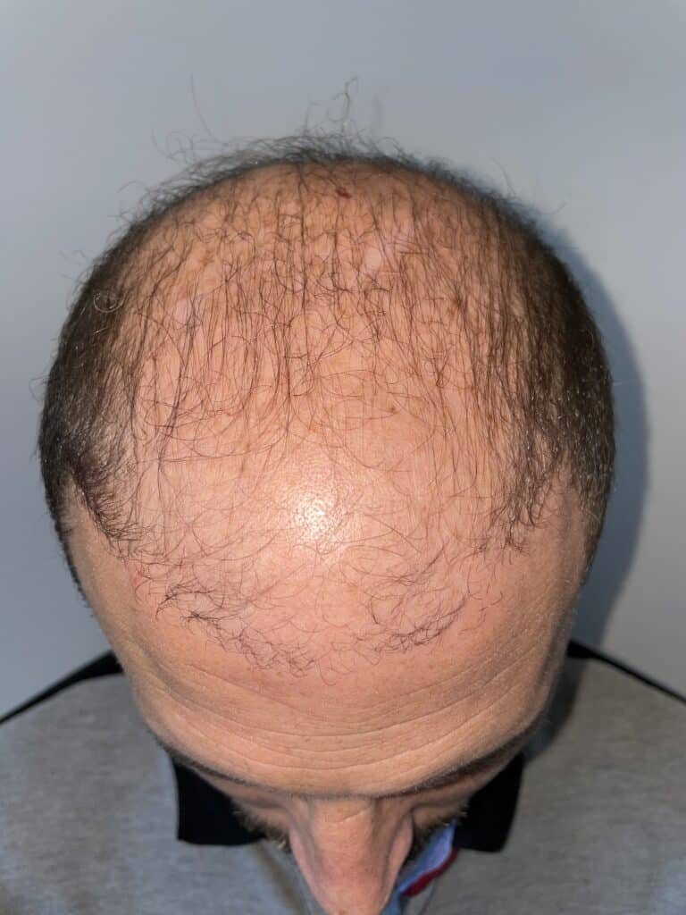 Non-Surgical Hair Loss Treatment | Regrowth of Thinning Hair